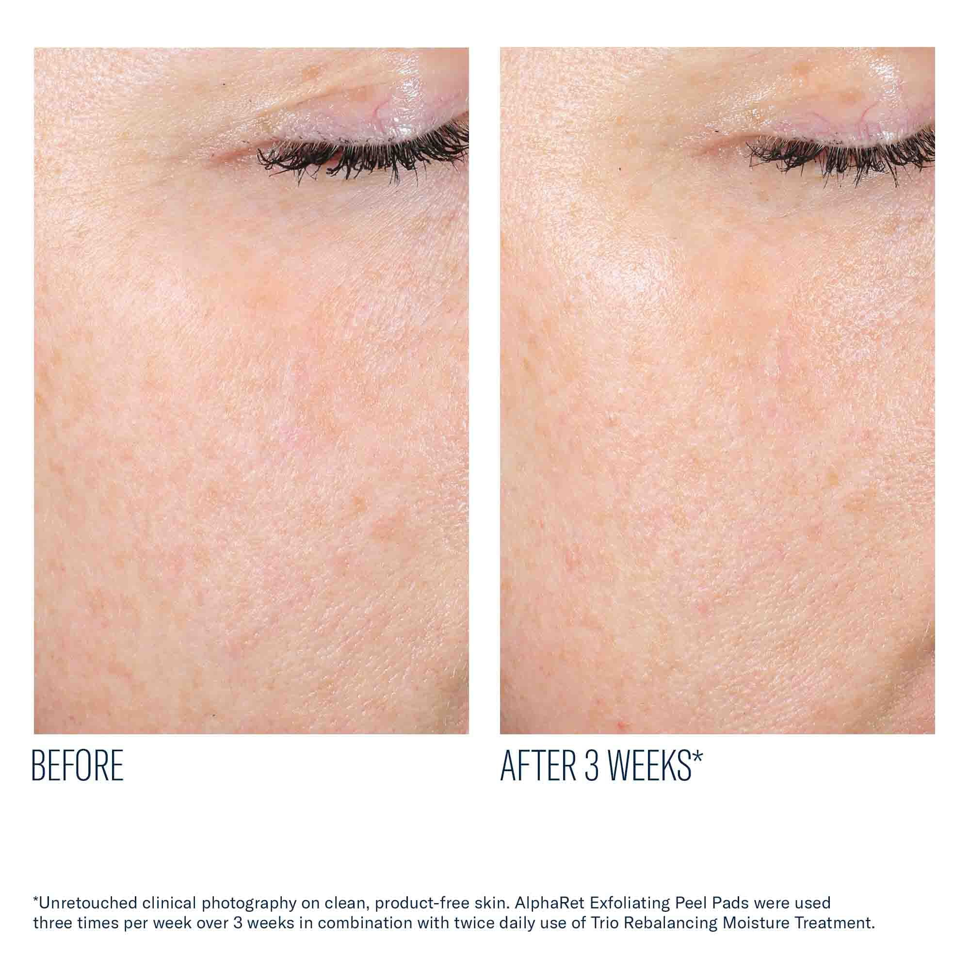 AlphaRet Exfoliating Peel Pads
