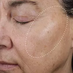 Baseline skin texture (before treatment)