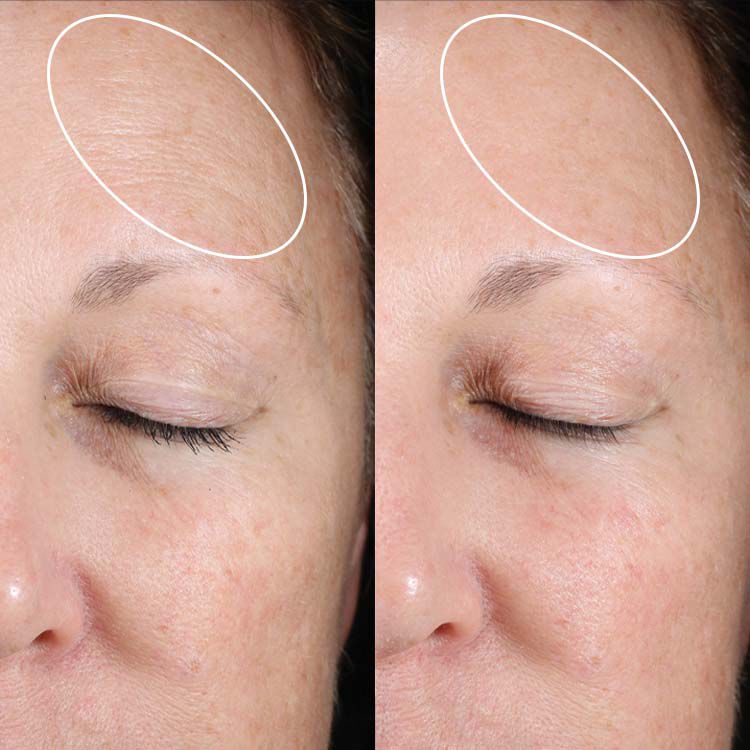 Anti-Aging Results​  With Little-to-no Irritation