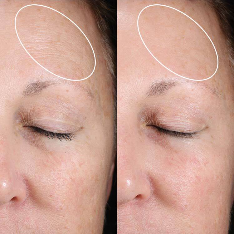 Anti-Aging Results With Little-to-no Irritation