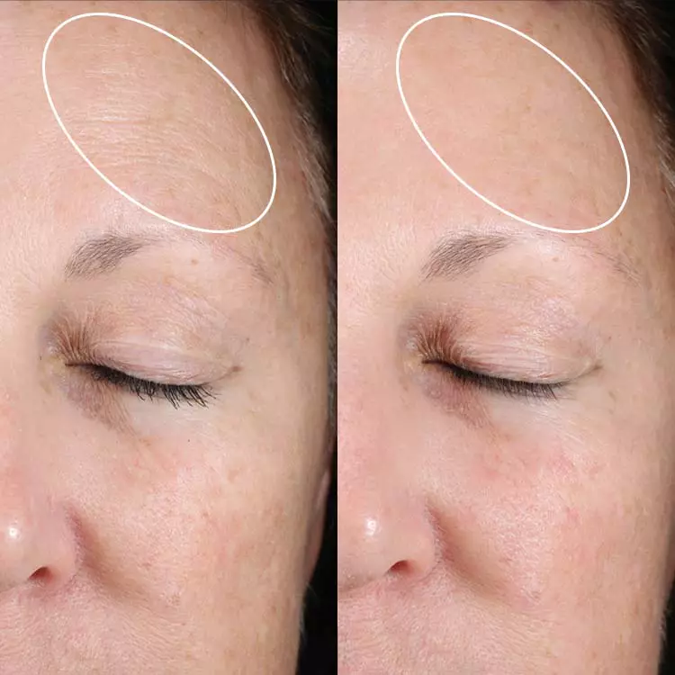 Anti-Aging Results With Little-to-no Irritation