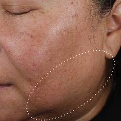 Baseline skin texture (before treatment)