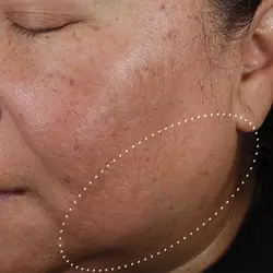 Baseline skin texture (before treatment)