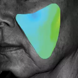 Baseline skin texture (before treatment)