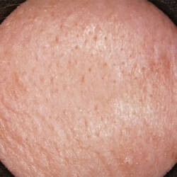 Baseline skin texture (before treatment)