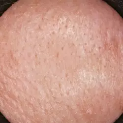 Baseline skin texture (before treatment)