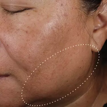 skin texture after 12 weeks of treatment