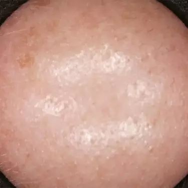 skin texture after 12 weeks of treatment
