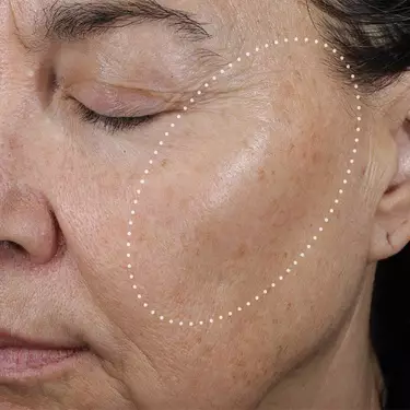 skin texture after 12 weeks of treatment